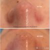 MEDI-FACIAL® - Pore Cleansing Express Treatment - Image 2