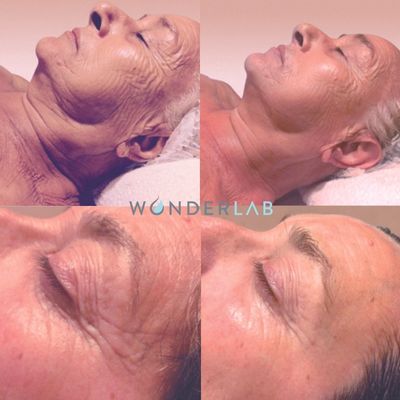 Wrinkle reduction