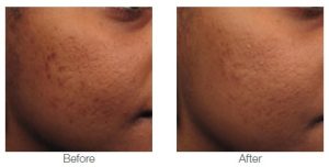 picoway vs picosure for acne scars