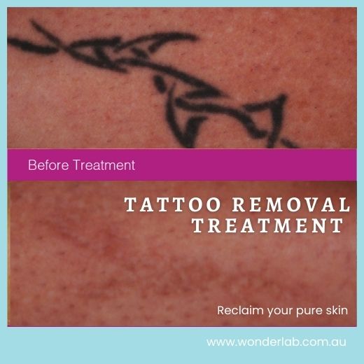 PicoWay vs PicoSure for Tattoo Removal